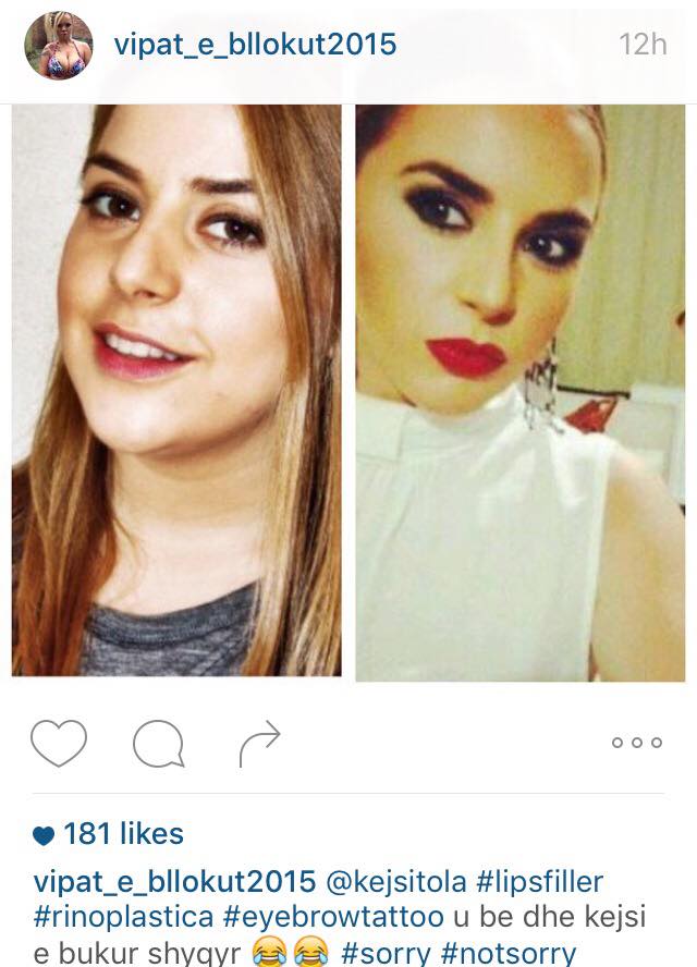 Operacionet plastike, vipat kërcënojnë faqen në Instagram