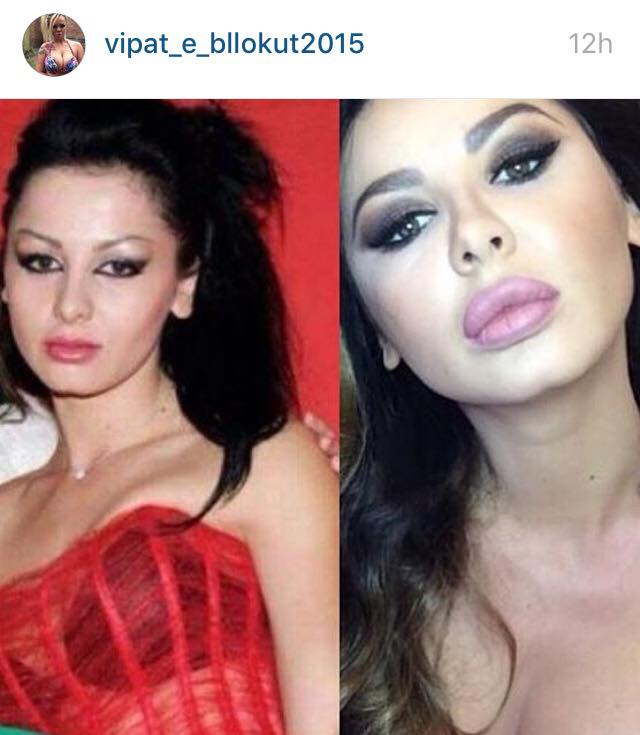 Operacionet plastike, vipat kërcënojnë faqen në Instagram