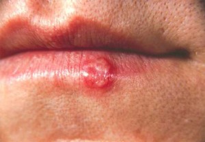 herpes-in-mouth-symptoms