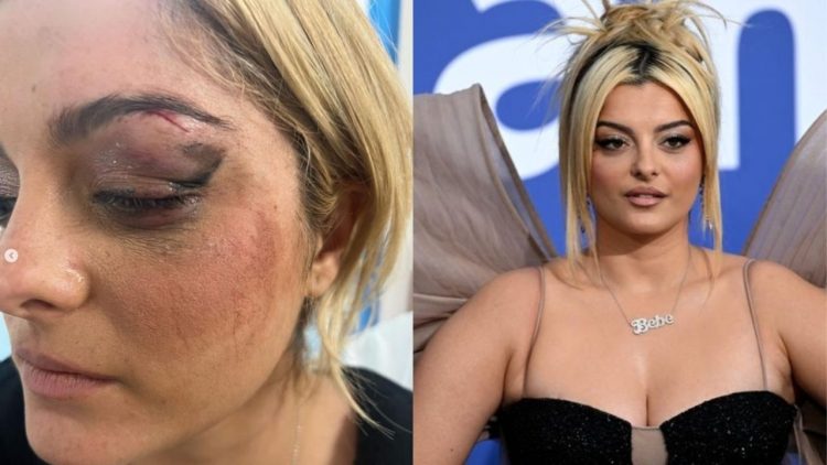Arrestohet i riu që sulmoi Bebe Rexhën, këngëtarja poston foton pas 3 qepjeje në fytyrë
