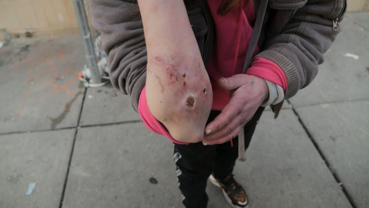 Rritja e numrit të vdekjeve nga ‘droga zombie’ në Amerikë alarmon Shtëpinë e Bardhë