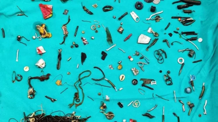 Indi/ 35-vjeçari shkoi në spital me dhimbje barku, mjekët i heqin 60 objekte nga zorra