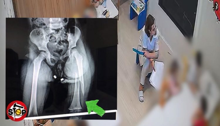 Edukatorja dhunon 3-vjeçaren në kopshtin privat/ E mitura dërgohet me këmbë të thyer në spital