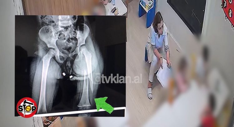 Sigurohet rehabilitimi i 3-vjeçares që i theu këmbën edukatorja