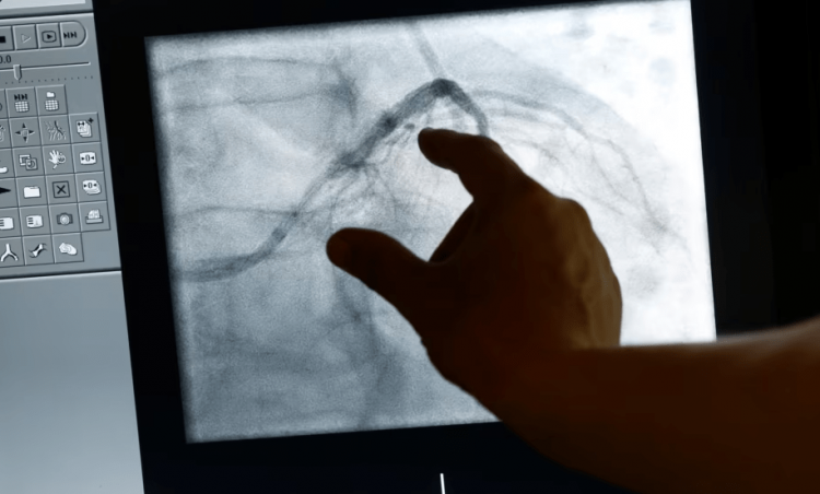 Diagnostikimi me inteligjencën artificiale i sëmundjeve të zemrës dhe kancerit