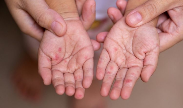 Arrin në 18 numri i të prekurve me fruth, shumica e të infektuarve në Durrës dhe Tiranë