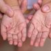 Arrin në 18 numri i të prekurve me fruth, shumica e të infektuarve në Durrës dhe Tiranë
