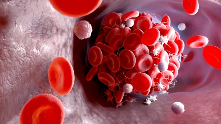 Në Shqipëri rreth 250 persona me Hemofili/ Ky çrregullim i gjakut është i trashëgueshëm e prek më shumë meshkujt