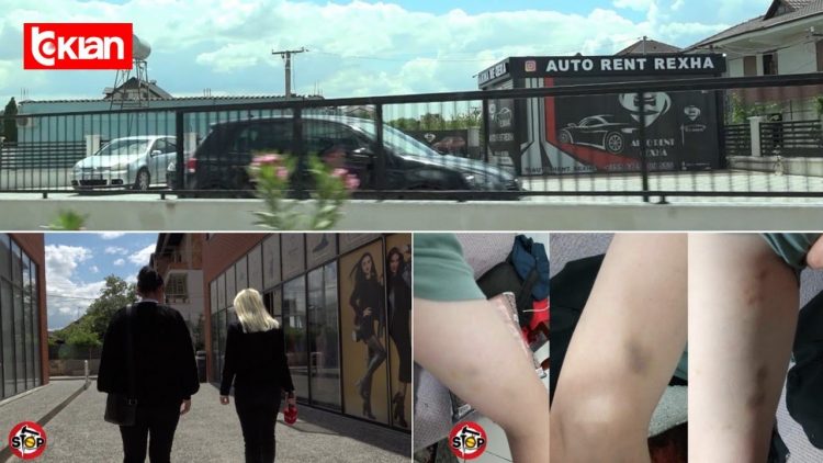 “Më goditën me bishtin e fshesës e grushte”, qytetarja dhunohet barbarisht nga ish-vjehrra dhe kushëriri i saj