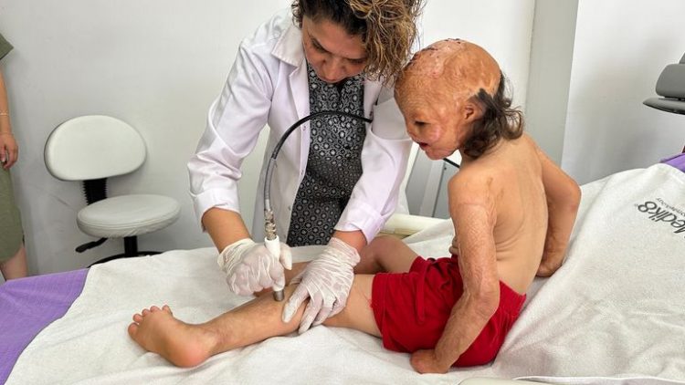 “Fëmija mrekulli”/ U dogj në zjarrin e tendës, si mbijetoi vajza siriane pas një sërë operacionesh