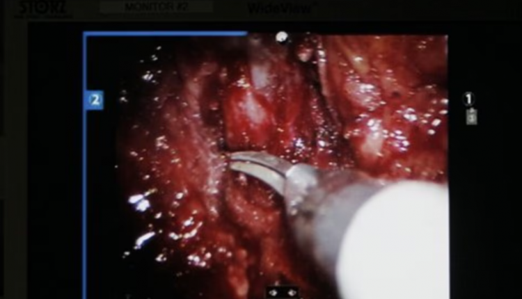 Britani, për herë të parë një fëmijë operohet me ndihmën e robotëve