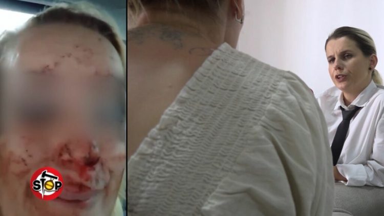 Dhunë barbare ndaj ish-partneres, policia lë të lirë agresorin