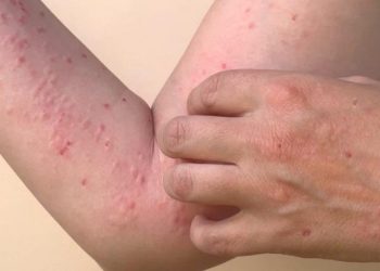 Shfaqet lija e majmunit në Shqipëri, prek një 30-vjeçar