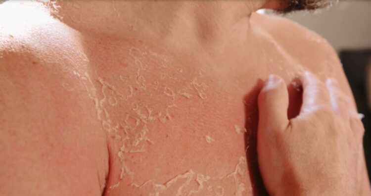 Vera shton rastet me infeksione në lëkurë